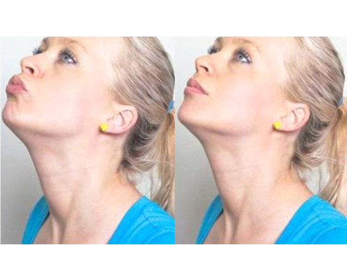 Chin Lift Chin Lift
